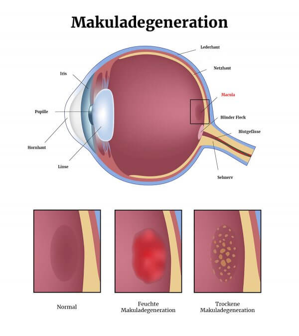 Makuladegeneration Augenklinik Teufen