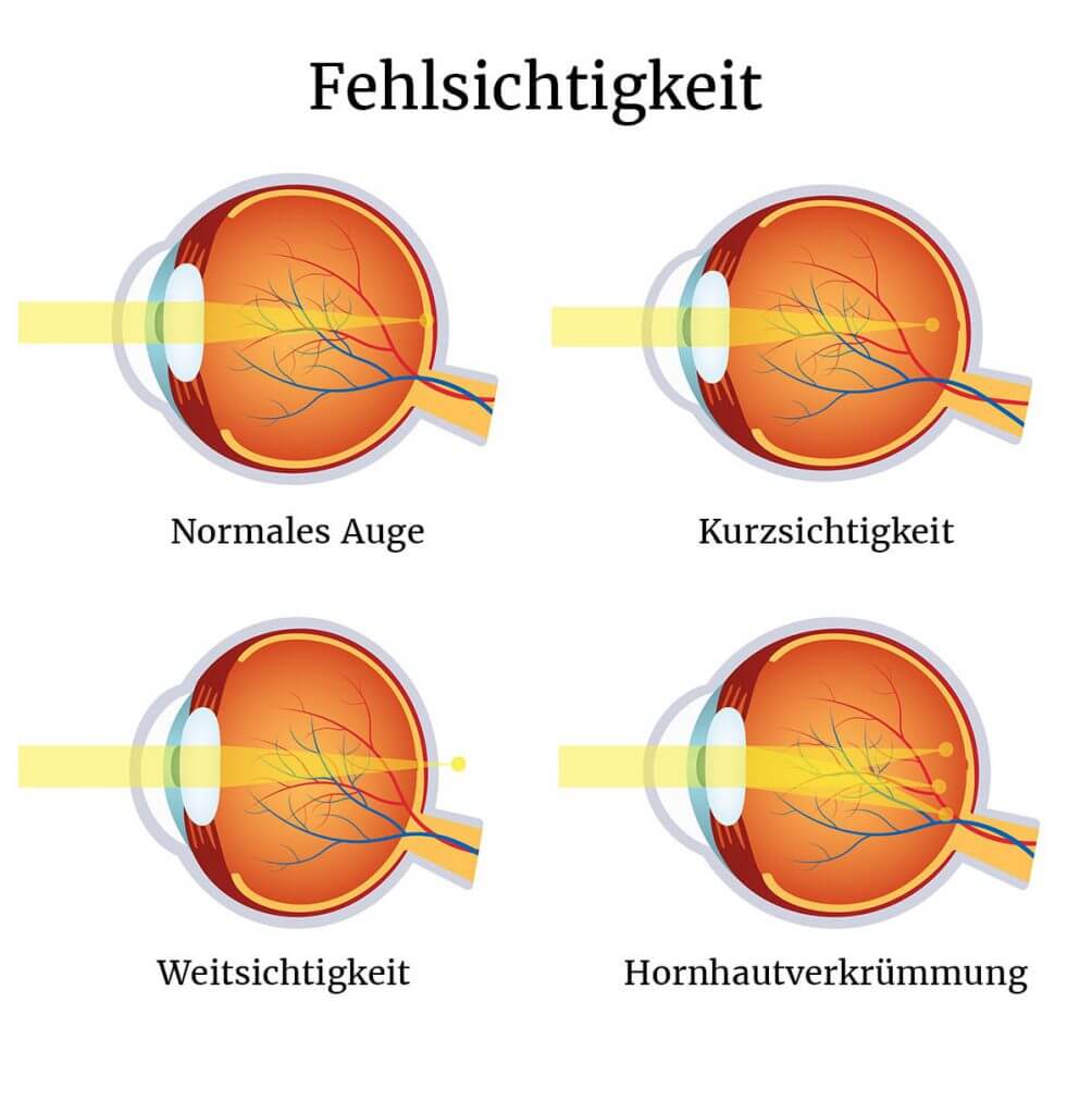Fehlsichtigkeiten I Überblick & Behandlungsformen aller Fehlsichtigkeiten