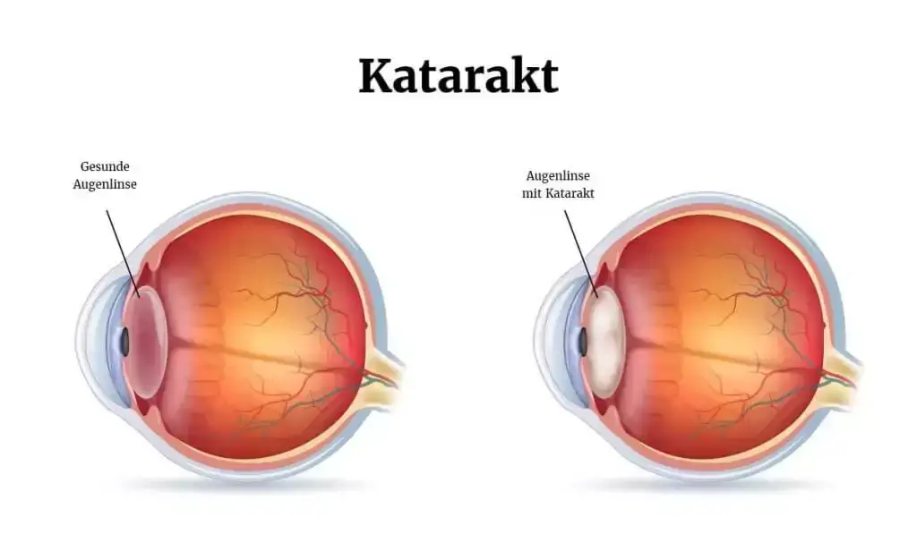 Grauer Star Behandlung Katarakt Augenarzt Teufen